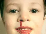 Hemorragia nasal en un niño.