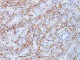 Células tumorales de cáncer de páncreas del modelo Kras del CNIO, mostrando en color marrón la expresión de Galectina-1