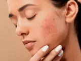 El uso de la mascarilla está provocando brotes de acné.