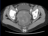 Imagen de un escáner de un caso de cáncer de ovarios.
