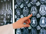 Combinan imágenes en 3D e inteligencia artificial para diagnosticar el grado de afección del Parkinson