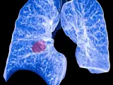 El cáncer de pulmón precoz hace que las células inmunitarias ayuden a los tumores a invadir los pulmones