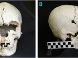 Cráneo encontrado en isla caribeña muestra evidencia de lepra.