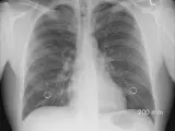 La enfermedad pulmonar obstructiva crónica es una afección pulmonar inflamatoria crónica que provoca la obstrucción del flujo de aire de los pulmones.