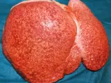 Imagen de un hígado con cirrosis