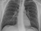 Radiografía de un paciente con neumonía, una complicación frecuente en los pacientes con fibrosis quística