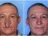 El antes y el después de un hombre con rinofima, tras ser operado.