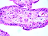 Muestra de tejido de placenta infectada por citomegalovirus.