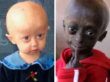 La progeria es una de las enfermedades más raras y devastadoras que sufren los niños.