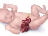 Ilustración de un bebé con gastrosquisis.