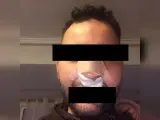 Presunta víctima de los vigilantes de una discoteca en Valencia con fractura nasal.