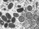 Imagen microscópica del virus de la viruela del mono.