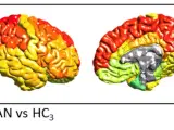Estos mapas cerebrales muestran las regiones cerebrales con déficits de materia gris en la anorexia.