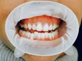 La enfermedad periodontal afecta a las encías y la mandíbula