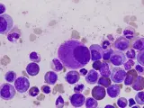 Imagen microscópica de la leucemia mieloide crónica