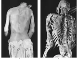 Apariencia clínica y esqueleto de un hombre con FOP.