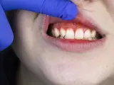 Unos dientes con sangrado de encías.