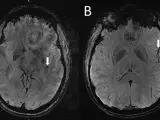 Imagen del cerebro en la que se señalan lesiones del cerebro aparentes en la migraña.
