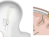 Imagen del dispositivo que la compañía pretende colocar en cabezas humanas para conectar los cerebros a máquinas.