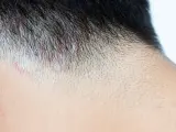 Lesiones típicas de la tiña en el cuero cabelludo de un hombre