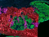 Mapa del cáncer de colon.