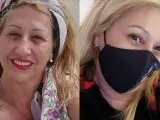 Maribel, antes de la cirugía y después con mascarilla