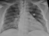 La radiografía de tórax de un paciente positivo de COVID-19 que muestra una neumonía en la parte inferior de los pulmones.