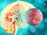 Tumor en el cerebro