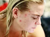 Mujer joven con acné