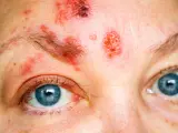 Herpes zóster en la cara y alrededor del ojo, llamado herpes zóster oftálmico.