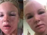 La brutal quemadura de una joven en la playa: "Me quedé dormida y me quemé tanto que parecía un extraterrestre"