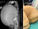 Montaje de fotos de la tomografía del quiste, junto a la imagen externa del vientre de la paciente.