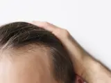 Un 70% de los hombres sufre alopecia androgénica.