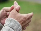 La artritis comienza a manifestarse por las articulaciones pequeñas, en manos y pies.