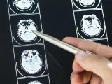 Closeup of brain MRI scan result