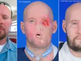Un hospital de Nueva York logró por primera vez trasplantar un ojo entero, media cara incluida, a un paciente de 46 años que había sufrido un grave accidente laboral en el que perdió su nariz, su boca y el brazo izquierdo.