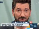 Diego Revuelta muestra el resultado de su tratamiento con bótox.