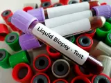 La biopsia líquida se realiza con una simple analítica de sangre.