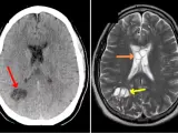Escáneres cerebrales que muestran las lesiones del paciente.