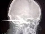 Radiografía del paciente, con el arpón clavado en la cabeza.