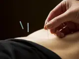 La acupuntura es una técnica que ayuda a la fertilidad en casos de endometriosis.