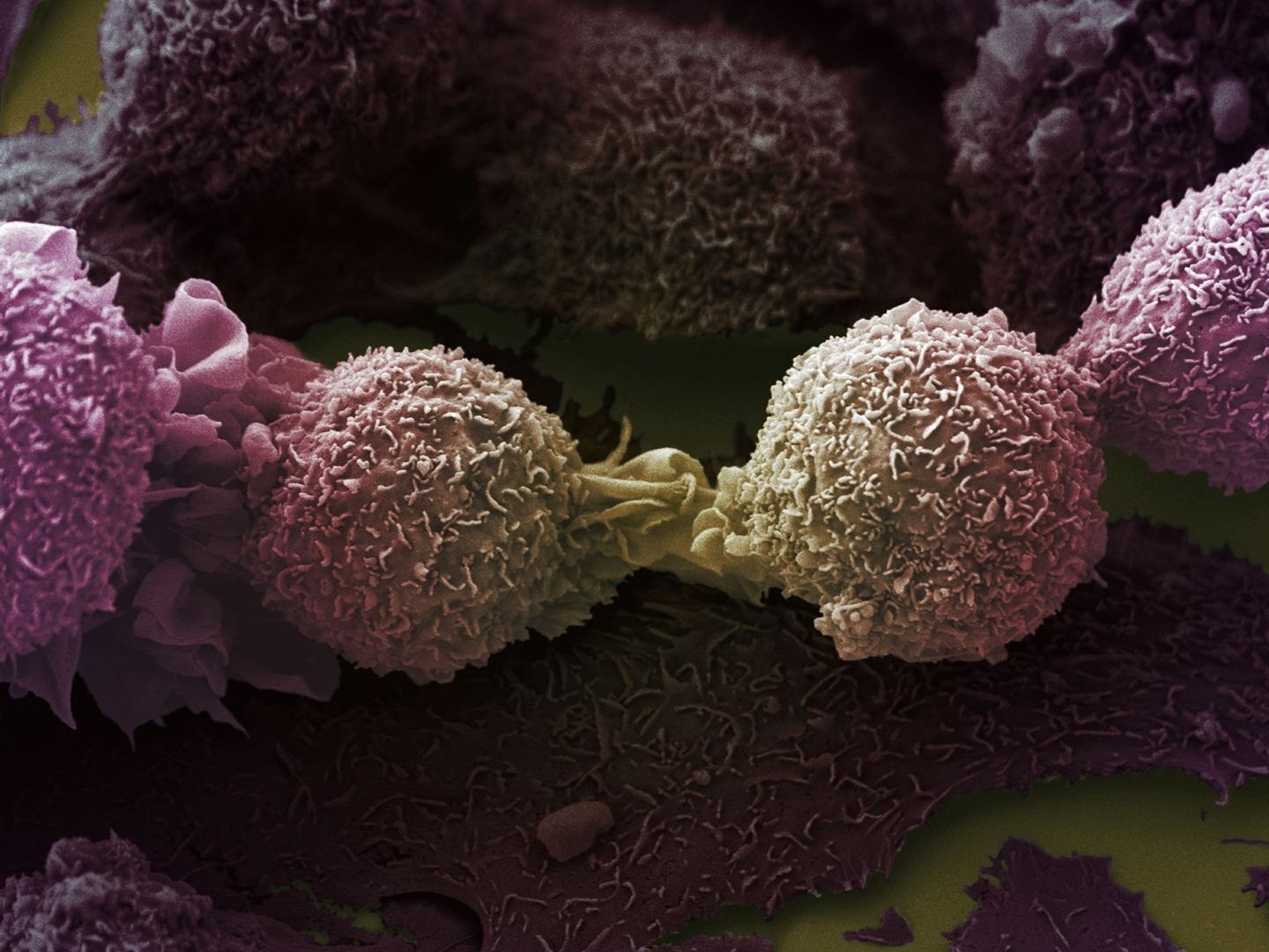 Imagen de microscopía electrónica de células de cáncer de pulmón.