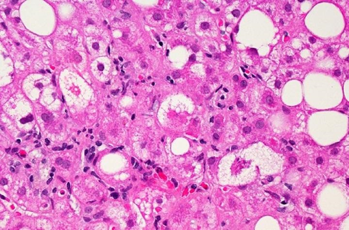 Liver tissue affected by nonalcoholic fatty liver disease.