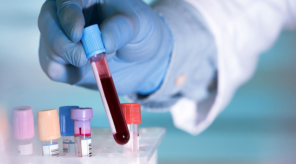 A Blood Test Will Reveal When Benign Tumors In The Neurofibromatosis Type Turn Cancerous.