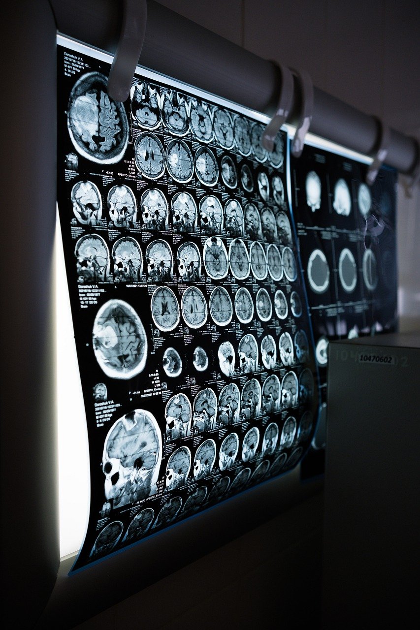One study used magnetic resonance imaging (MRI) to see how creative people's brains were.