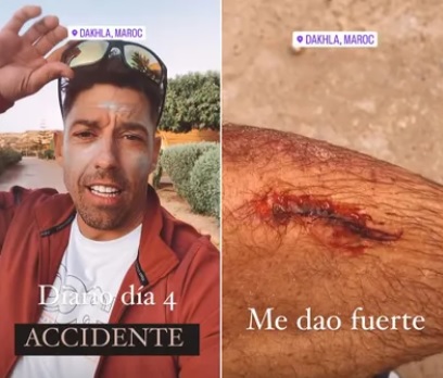 Actor Adrián Lastra shows his leg injury after suffering an accident.