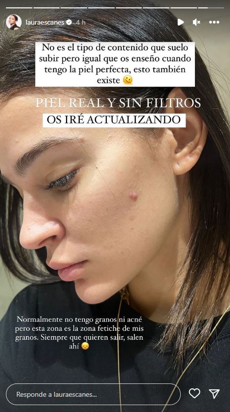 Laura Escanes shows her natural skin on Instagram