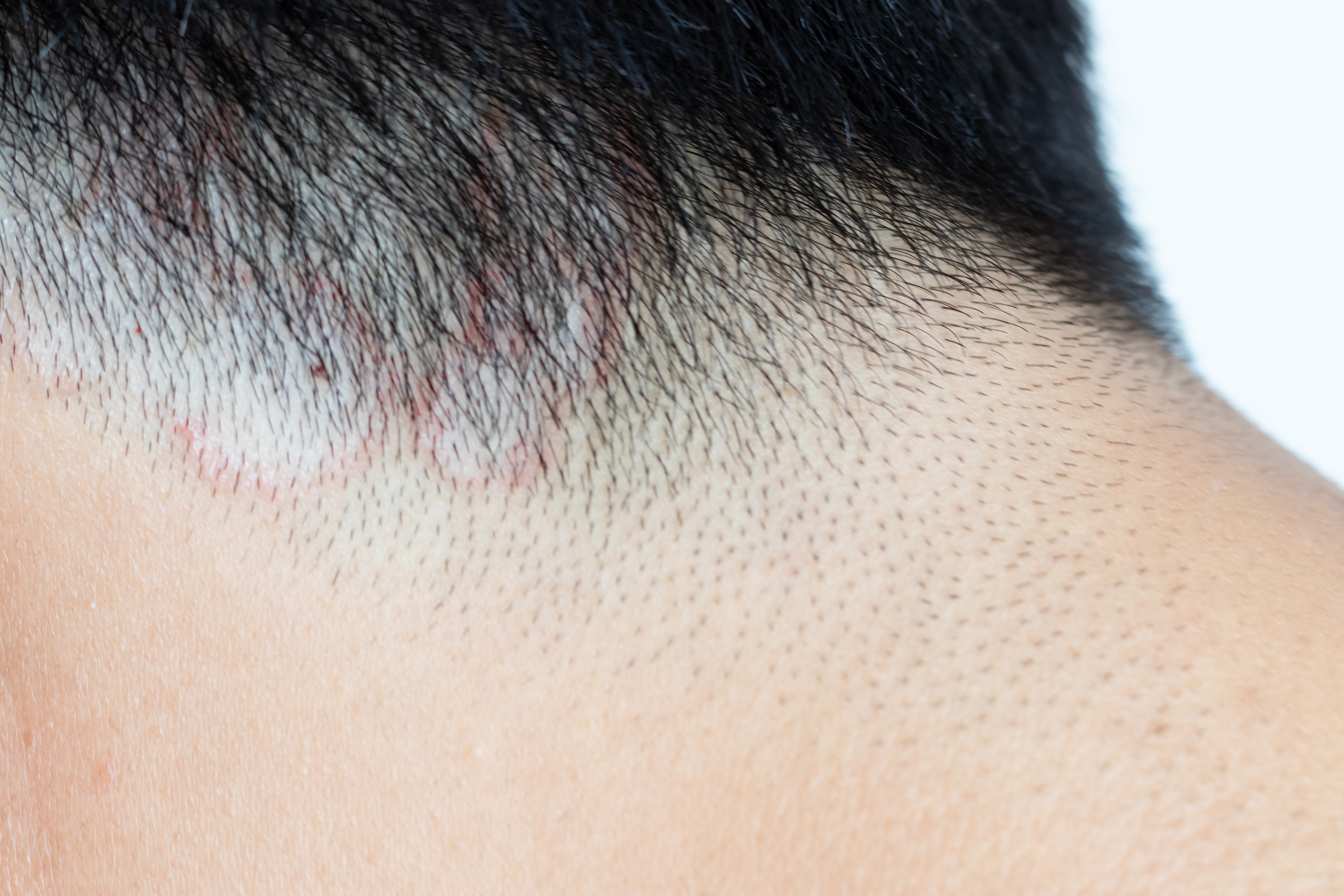 Typical ringworm lesions on the scalp of a man