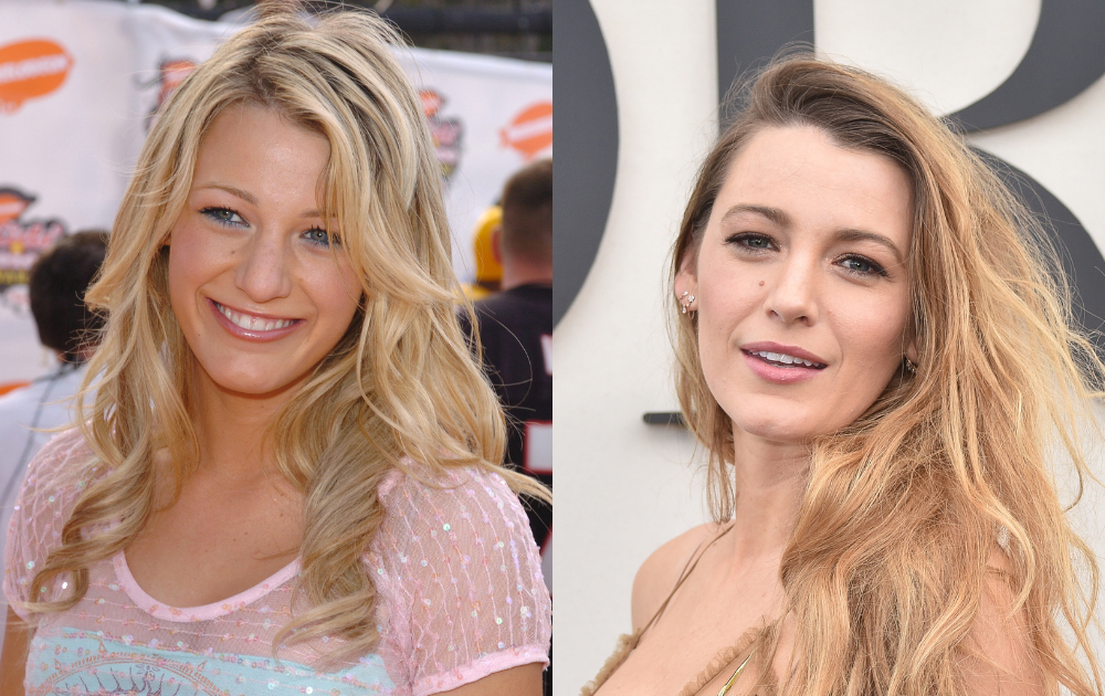 Blake Lively before and after her surgeries