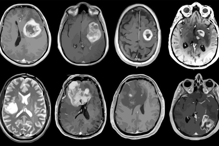 Glioblastoma, aggressive brain tumor mapped in genetic and molecular detail.